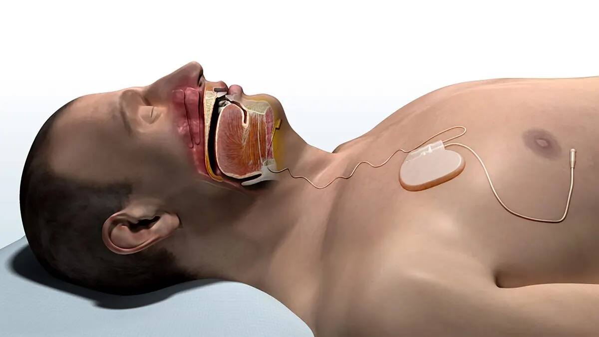 A consultation about implanted upper-airway stimulation