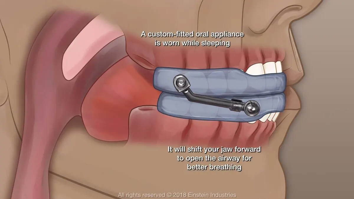 A dental consultation for a custom mandibular advancement device